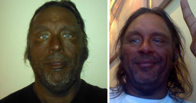Read more about the article Man who used Melanotan II injections for 20 years shares his warning